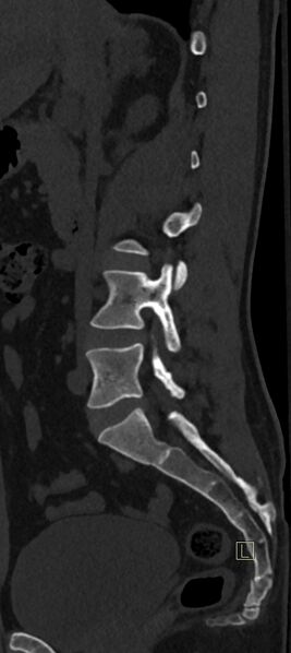 File:Calcaneal fractures with associated L2 burst fracture (Radiopaedia 71671-82493 Sagittal bone window 52).jpg