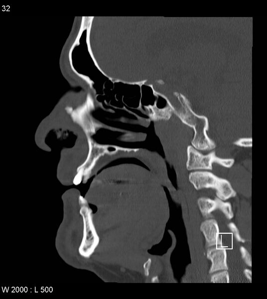 File:Calcification of the transverse band of the cruciform ligament (Radiopaedia 53063-59025 Sagittal bone window 9).jpg