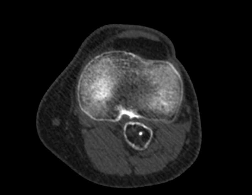 Calcified hematoma - popliteal fossa (Radiopaedia 63938-72763 Axial bone window 38).jpg