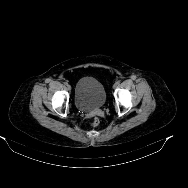 File:Calcified hydatid cyst (Radiopaedia 62000-70085 Axial non-contrast 99).jpg