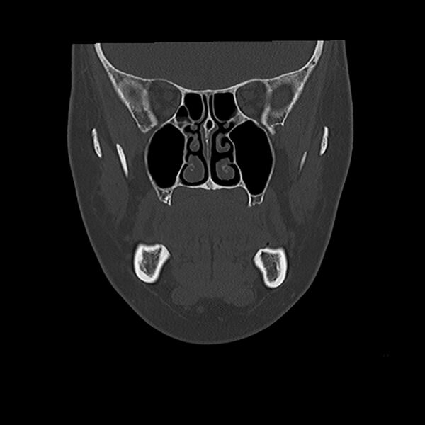 File:Canal up mastoidectomy (Radiopaedia 78108-90638 Coronal bone window 12).jpg