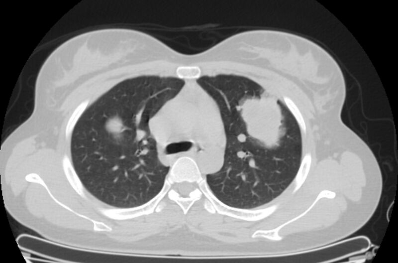 File:Cannonball metastases - uterine choriocarcinoma (Radiopaedia 70137-80173 Axial lung window 25).jpg
