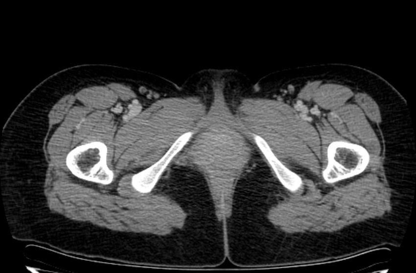Cannonball metastases - uterine choriocarcinoma (Radiopaedia 70137-80174 A 78).jpg
