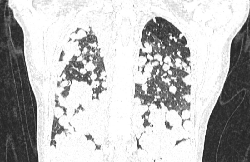 File:Cannonball metastases from breast cancer (Radiopaedia 91024-108569 Coronal lung window 116).jpg