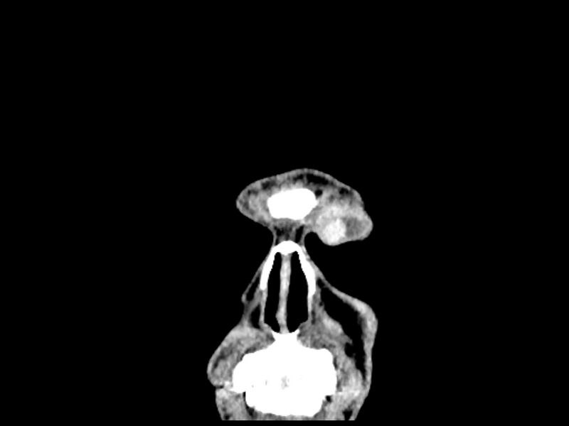File:Capillary hemangioma of the orbit (Radiopaedia 44610-48358 B 9).jpg