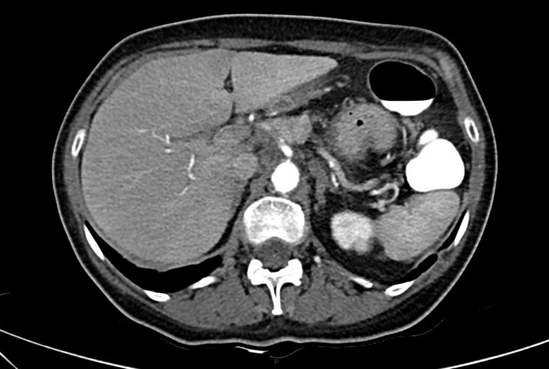 File:Carcinoid mesenteric tumor complicated by chylous ascites (Radiopaedia 76312-88926 A 18).jpg