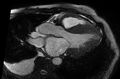 Cardiac amyloidosis (Radiopaedia 61600-69579 B 5).jpg