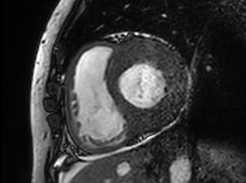 Cardiac amyloidosis (Radiopaedia 61600-69579 Short axis bSSFP 268).jpg