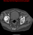 Cardiac perforation following transcatheter aortic valve implantation (Radiopaedia 23714-23863 B 2).png