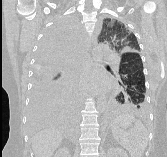 File:Cardiogenic pulmonary edema (Radiopaedia 29213-29609 Coronal lung window 45).jpg
