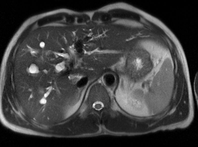 File:Caroli disease with medullary sponge kidney and nephrocalcinosis (Radiopaedia 10805-11251 Axial T2 1).jpg