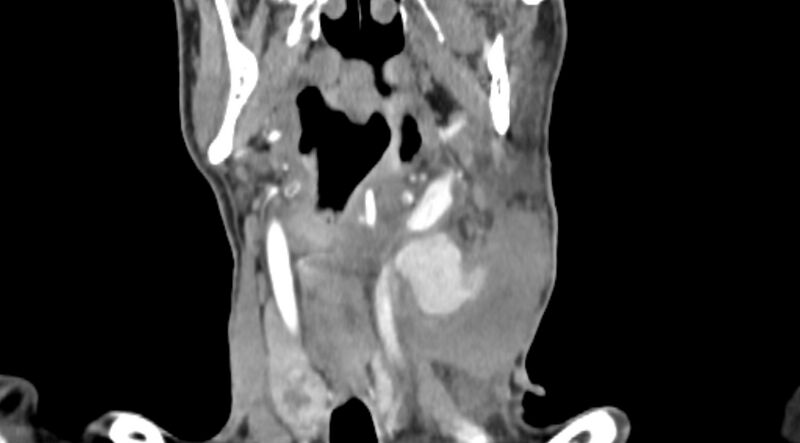 File:Carotid artery pseudoaneurysm (Radiopaedia 84030-99259 D 42).jpg