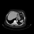Carotid body tumor (Radiopaedia 21021-20948 B 56).jpg