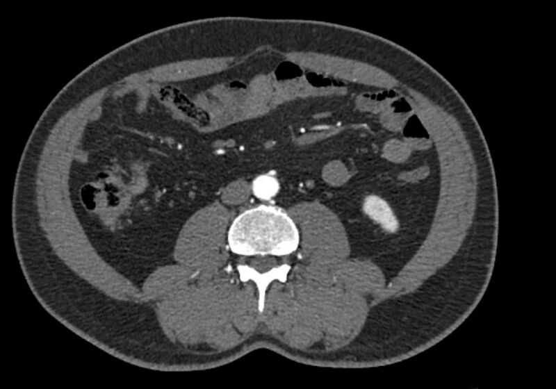 File:Celiac artery dissection (Radiopaedia 52194-58080 A 60).jpg