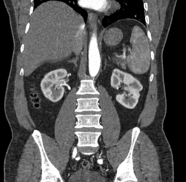 File:Celiac artery dissection (Radiopaedia 52194-58080 C 88).jpg