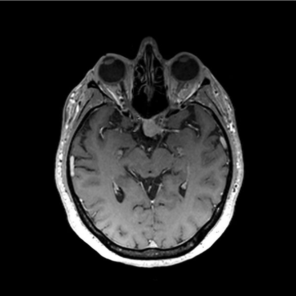 File:Central base of skull meningioma (Radiopaedia 53531-59549 Axial T1 C+ 26).jpg