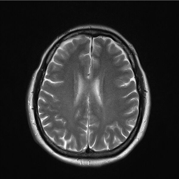 File:Central base of skull meningioma (Radiopaedia 53531-59549 Axial T2 14).jpg