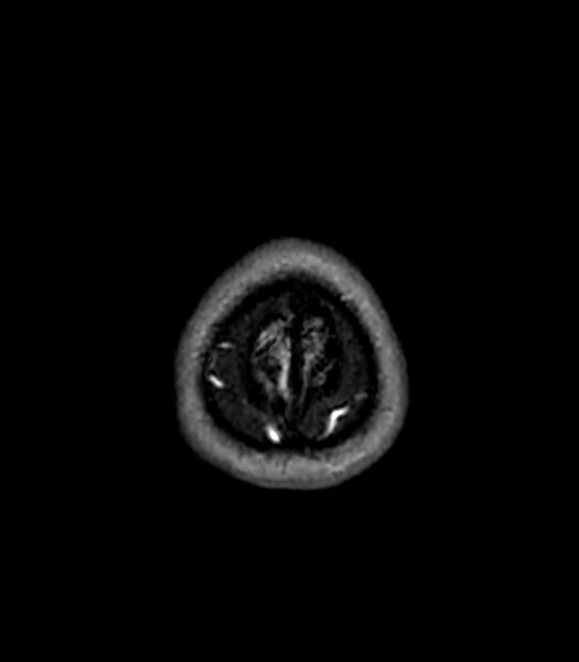File:Central neurocytoma (Radiopaedia 79320-92380 Axial FLAIR 30).jpg