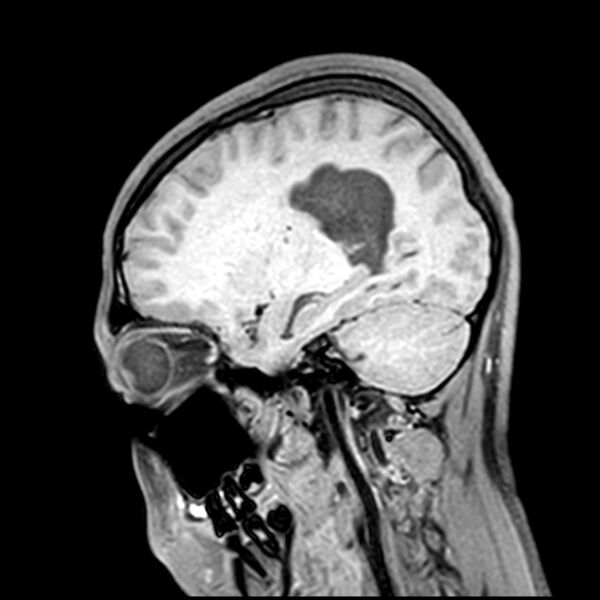 File:Central neurocytoma (Radiopaedia 79320-92380 Sagittal T1 176).jpg