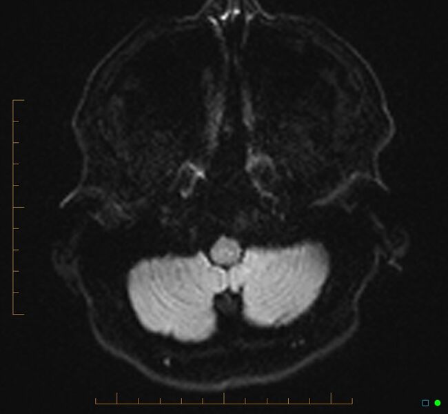 File:Cerebellar gangliocytoma (Radiopaedia 65377-74422 Axial DWI 4).jpg