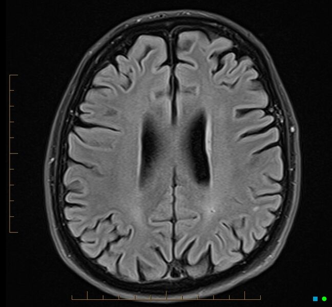 File:Cerebellar gangliocytoma (Radiopaedia 65377-74422 Axial FLAIR 26).jpg