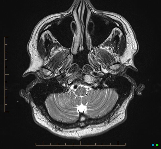 File:Cerebellar gangliocytoma (Radiopaedia 65377-74422 Axial T2 4).jpg
