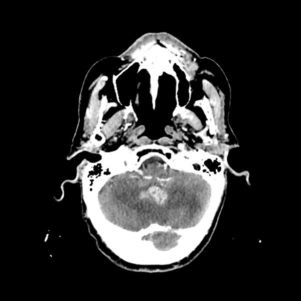 File:Cerebellar metastasis - lung tumor (Radiopaedia 69317-79145 Axial with contrast 8).jpg