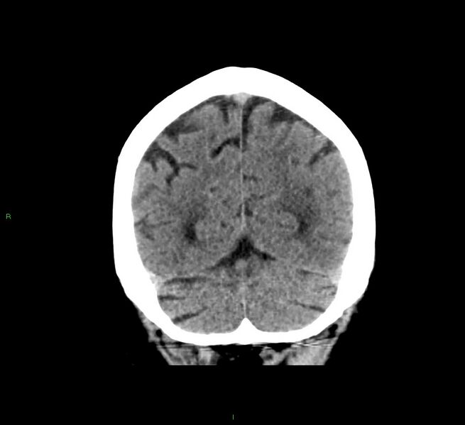 File:Cerebral amyloid angiopathy-associated lobar intracerebral hemorrhage (Radiopaedia 58376-65511 Coronal non-contrast 17).jpg