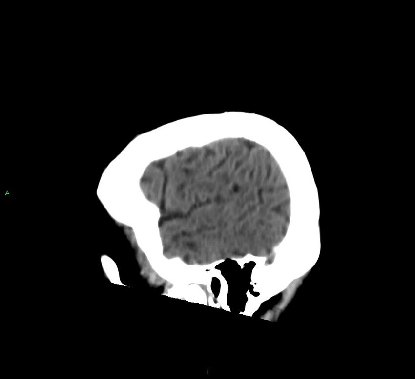 Cerebral amyloid angiopathy-associated lobar intracerebral hemorrhage (Radiopaedia 58376-65513 C 56).jpg