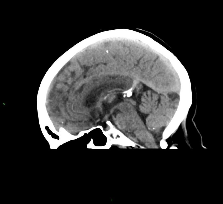 Cerebral amyloid angiopathy-associated lobar intracerebral hemorrhage (Radiopaedia 58378-65516 C 26).jpg