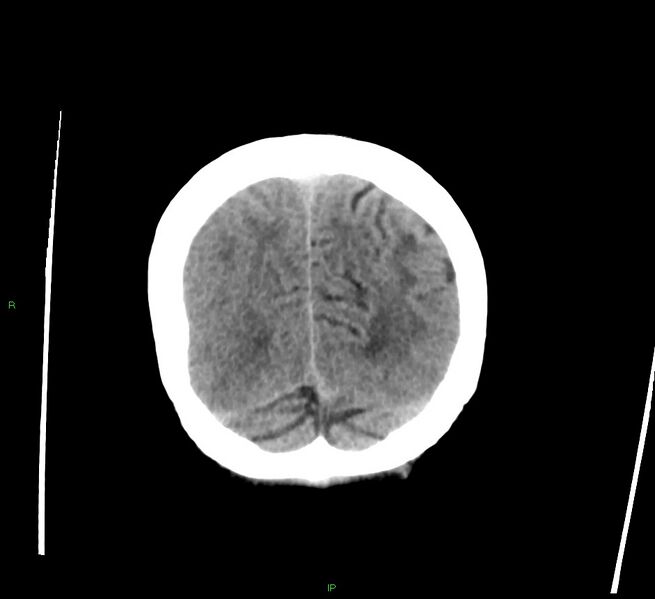 File:Cerebral amyloid angiopathy-associated lobar intracerebral hemorrhage (Radiopaedia 58378-65516 Coronal non-contrast 12).jpg