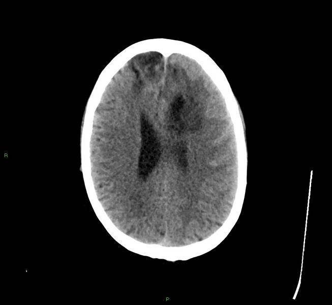 File:Cerebral amyloid angiopathy-associated lobar intracerebral hemorrhage (Radiopaedia 58529-65681 Axial non-contrast 19).jpg