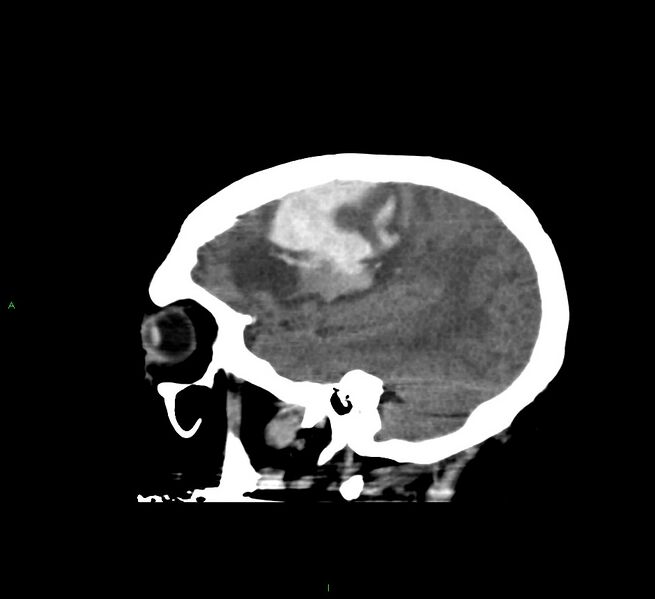 File:Cerebral amyloid angiopathy-associated lobar intracerebral hemorrhage (Radiopaedia 58560-65723 C 13).jpg