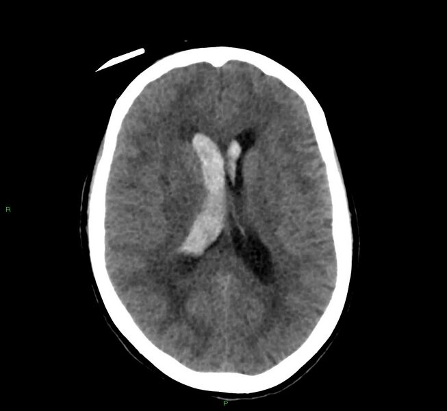File:Cerebral amyloid angiopathy-associated lobar intracerebral hemorrhage (Radiopaedia 58566-65730 Axial non-contrast 24).jpg