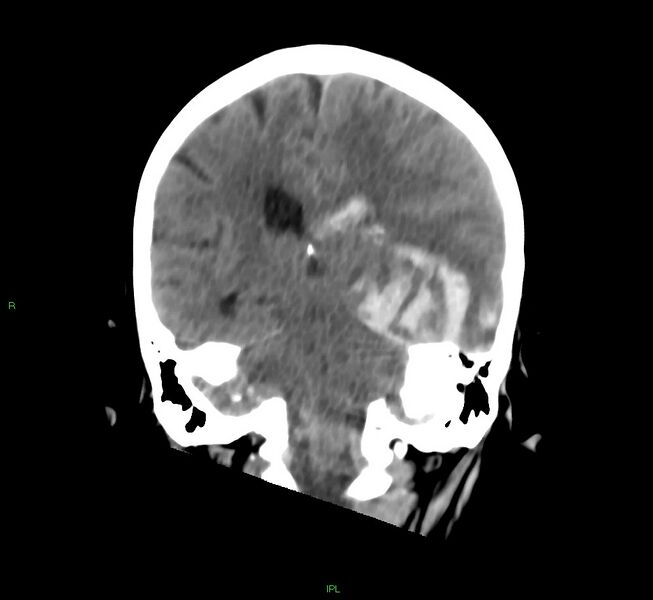 File:Cerebral amyloid angiopathy-associated lobar intracerebral hemorrhage (Radiopaedia 58754-65975 Coronal non-contrast 28).jpg