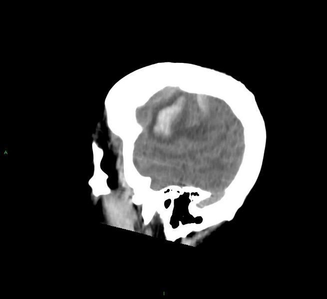 File:Cerebral amyloid angiopathy-associated lobar intracerebral hemorrhage (Radiopaedia 58756-65977 C 11).jpg