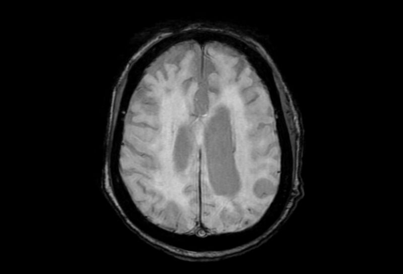 File:Cerebral amyloid angiopathy (Radiopaedia 86671-102792 Axial Gradient Echo 17).jpg