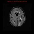 Cerebral and orbital tuberculomas (Radiopaedia 13308-13311 Axial FLAIR 12).jpg