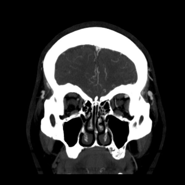 File:Cerebral arteriovenous malformation (Radiopaedia 43729-47189 C 8).jpg
