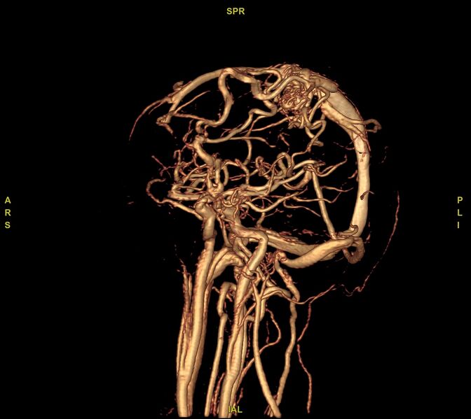 File:Cerebral arteriovenous malformation (Radiopaedia 61964-70029 VRT 48).jpg