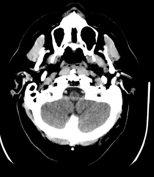 File:Cerebral dural venous sinus thrombosis (Radiopaedia 86514-102575 Axial non-contrast 6).jpg