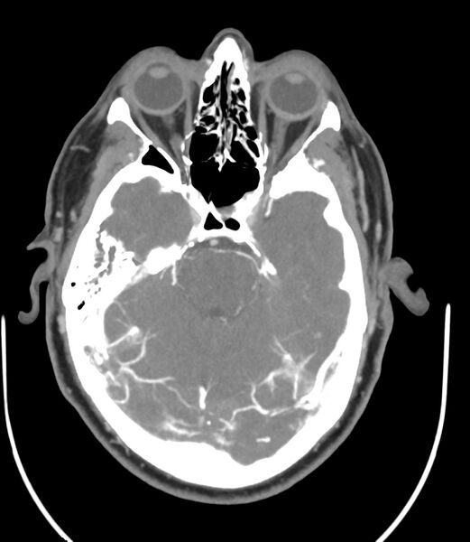 File:Cerebral dural venous sinus thrombosis (Radiopaedia 86514-102576 A 42).jpg