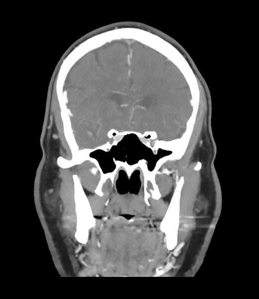 File:Cerebral dural venous sinus thrombosis (Radiopaedia 86514-102576 B 20).jpg