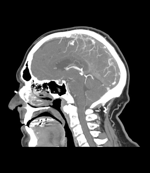 File:Cerebral dural venous sinus thrombosis (Radiopaedia 86514-102576 C 26).jpg