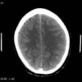 Cerebral hemorrhagic contusion with subdural and subarachnoid hemorrhage (Radiopaedia 10680-19197 Axial non-contrast 17).jpg
