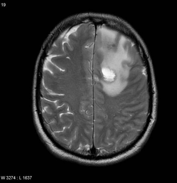File:Cerebral metastases - renal cell carcinoma (Radiopaedia 5510-7246 Axial T2 5).jpg