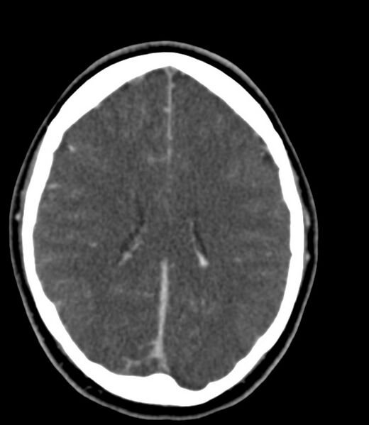 File:Cerebral venous sinus thrombosis (Radiopaedia 59224-66646 Axial C+ delayed 20).jpg