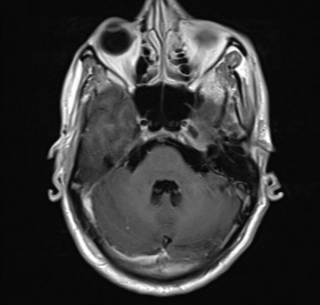 File:Cerebral venous thrombosis (Radiopaedia 71207-81504 Axial T1 C+ 7).jpg