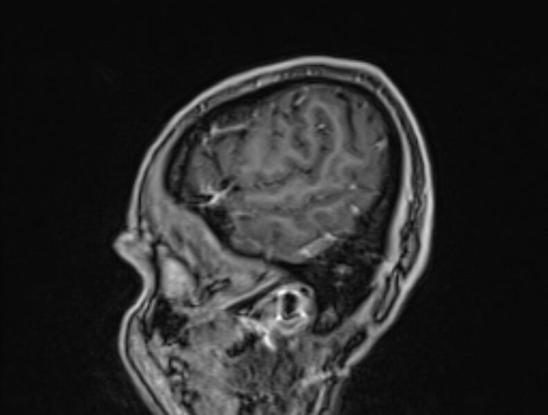 File:Cerebral venous thrombosis (Radiopaedia 71207-81504 Sagittal T1 C+ 58).jpg