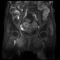 Cervical carcinoma (Radiopaedia 78847-91705 J 6).jpg